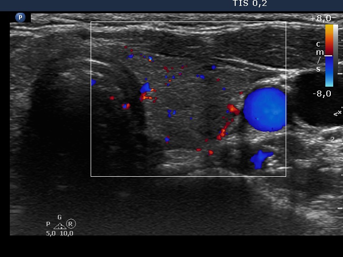 Right lobe, longitudinal scan