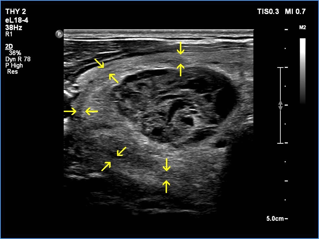 Right lobe, longitudinal scan
