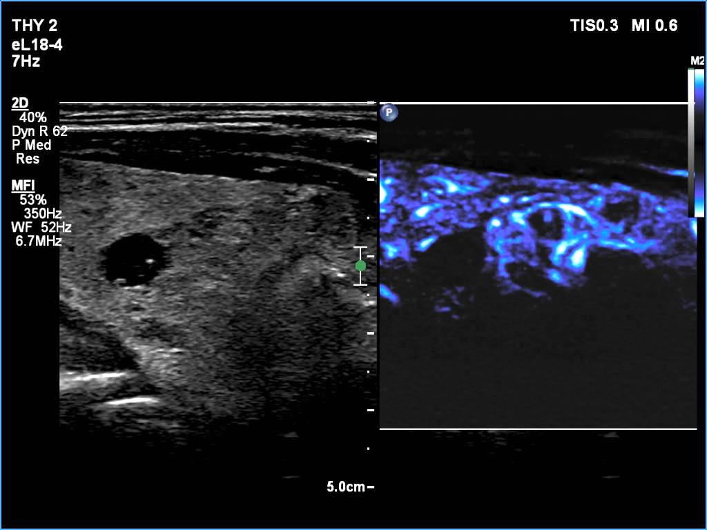 Right lobe, longitudinal scan