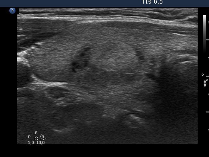 Right lobe, longitudinal scan