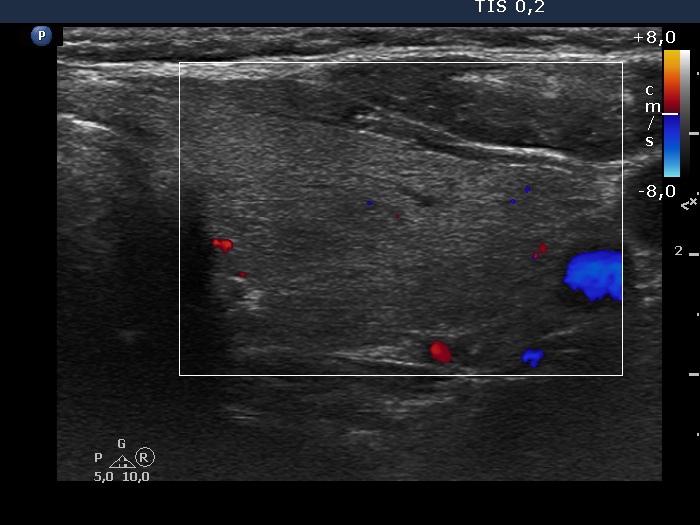 Right lobe, longitudinal scan