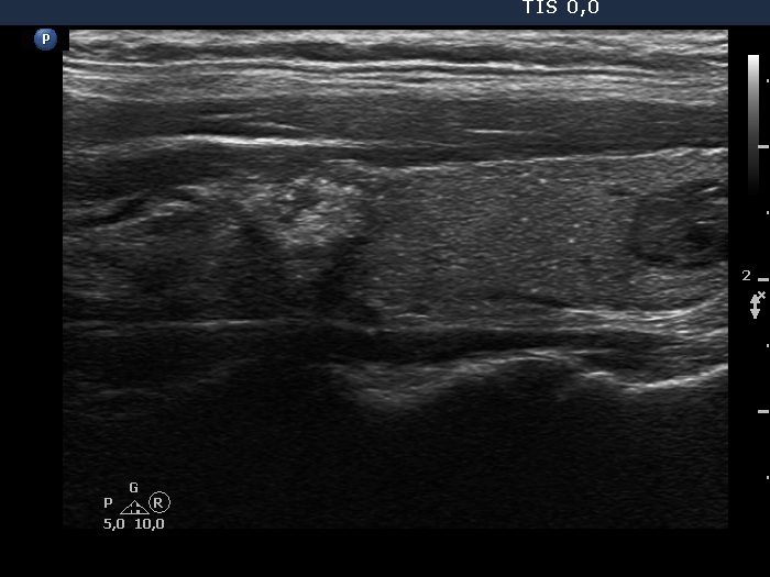 Right lobe, longitudinal scan