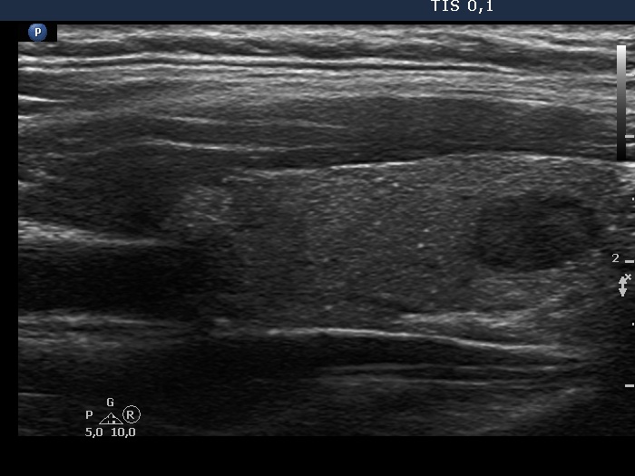 Right lobe, longitudinal scan