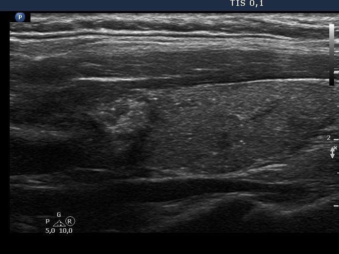 Right lobe, longitudinal scan