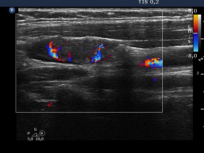 Right lobe, longitudinal scan