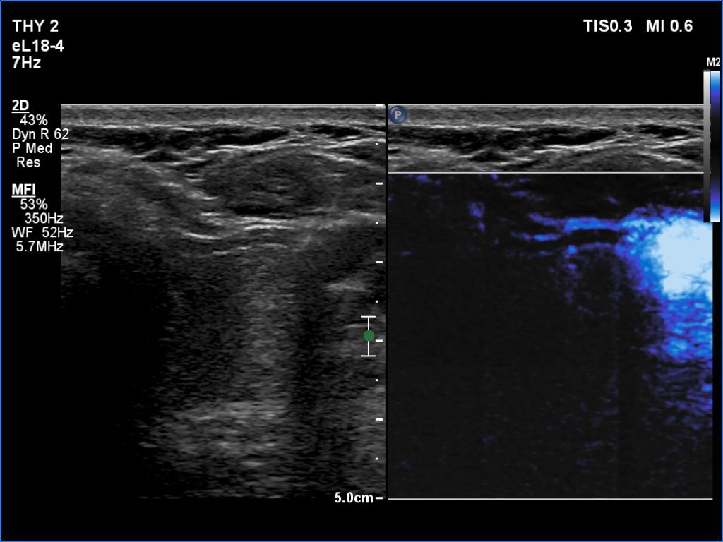 Right lobe, longitudinal scan