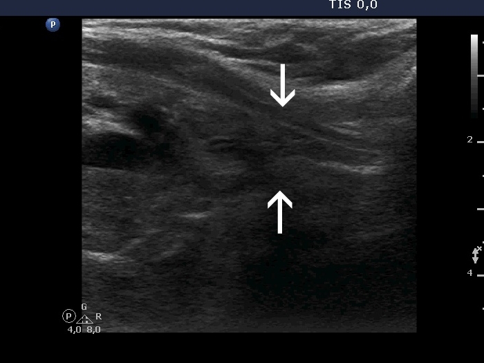 Right lobe, longitudinal scan