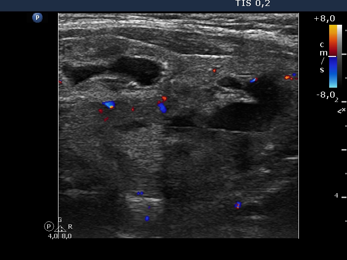 Right lobe, longitudinal scan