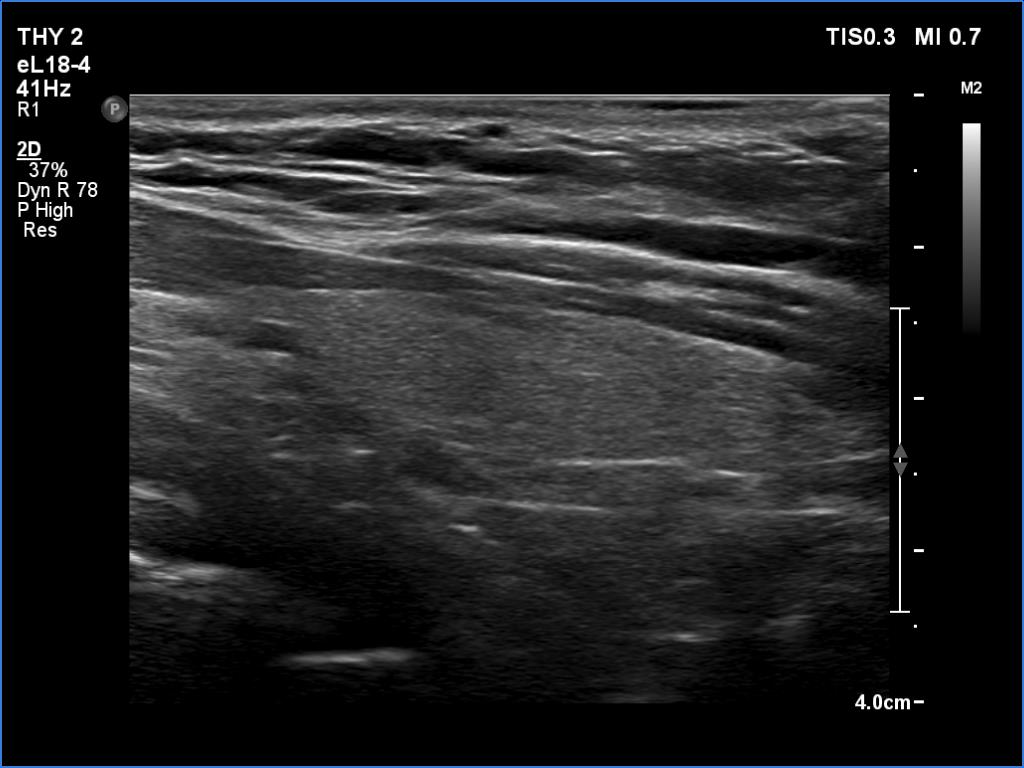Right lobe, longitudinal scan