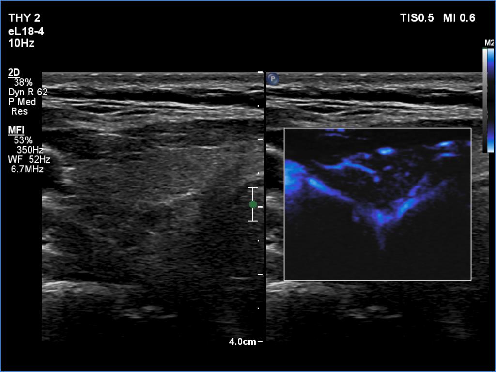 Right lobe, longitudinal scan