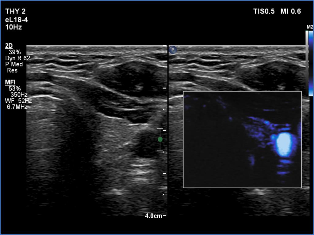 Right lobe, longitudinal scan