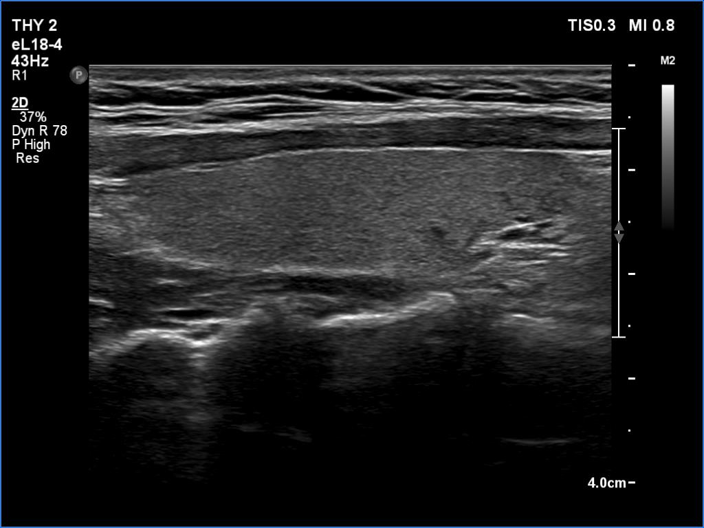 Right lobe, longitudinal scan