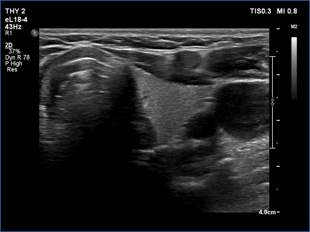 Right lobe, longitudinal scan