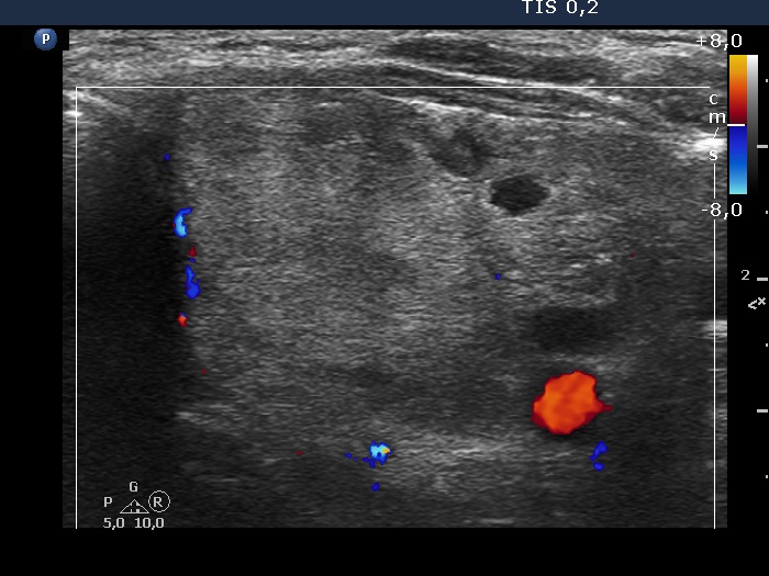 Right lobe, longitudinal scan