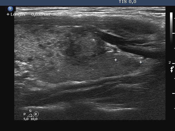 Right lobe, longitudinal scan