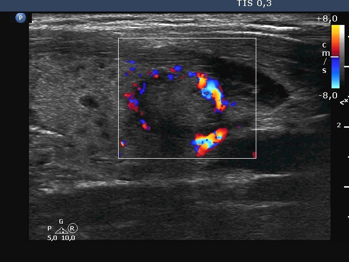 Right lobe, longitudinal scan