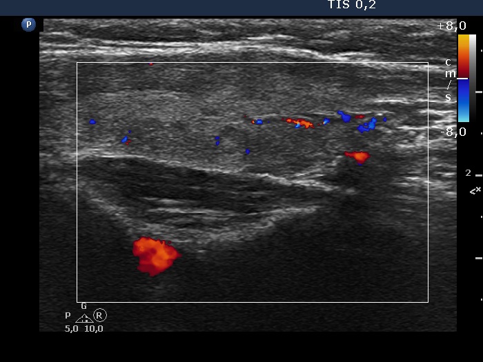Right lobe, longitudinal scan