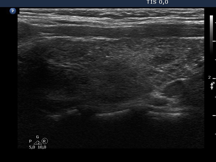 Right lobe, longitudinal scan