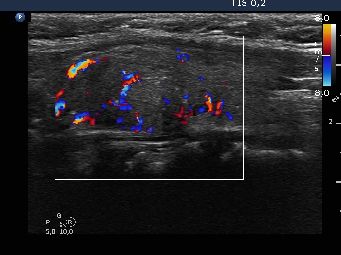 Right lobe, longitudinal scan