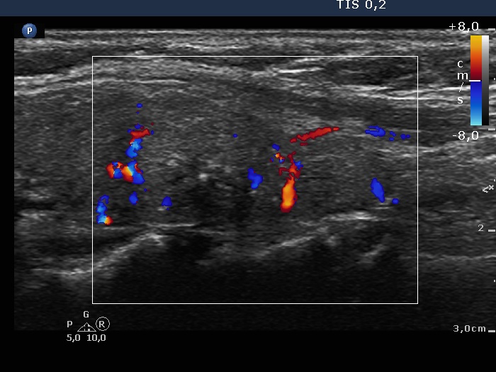 Right lobe, longitudinal scan
