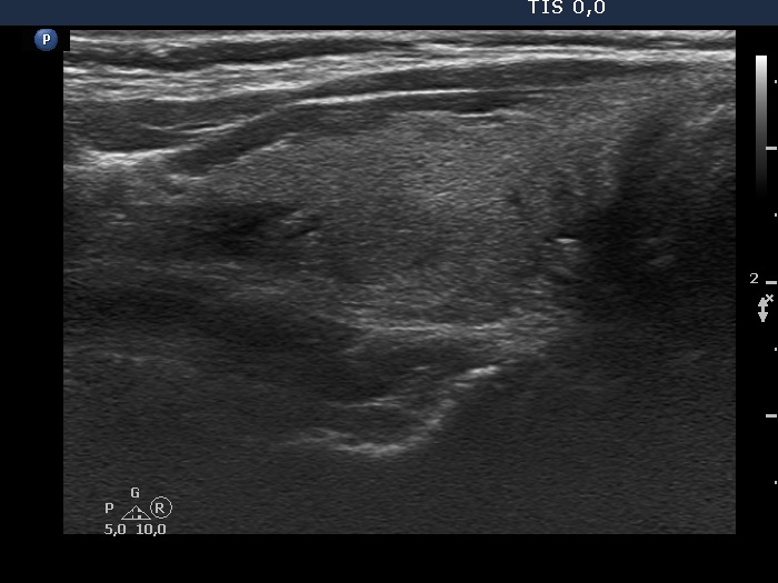 Right lobe, longitudinal scan