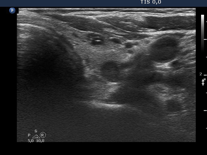 Right lobe, longitudinal scan