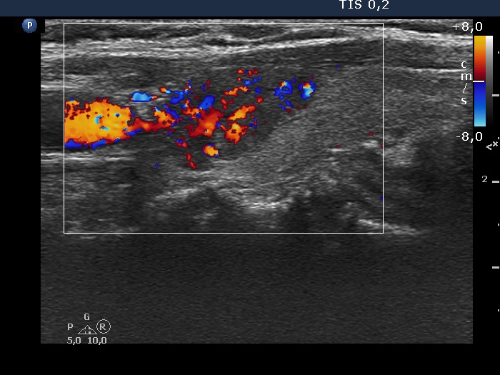Right lobe, longitudinal scan