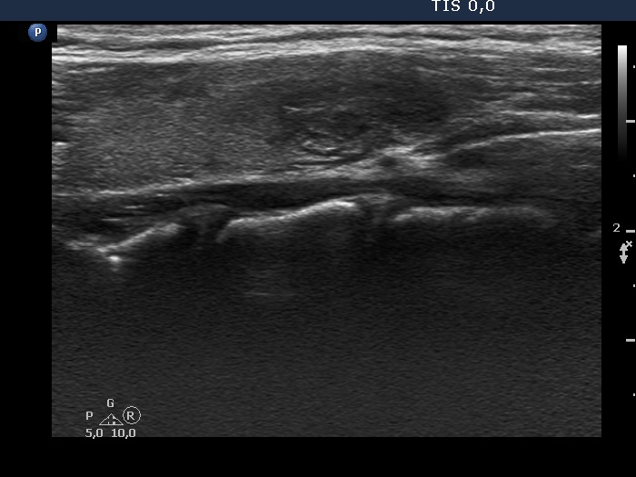Right lobe, longitudinal scan