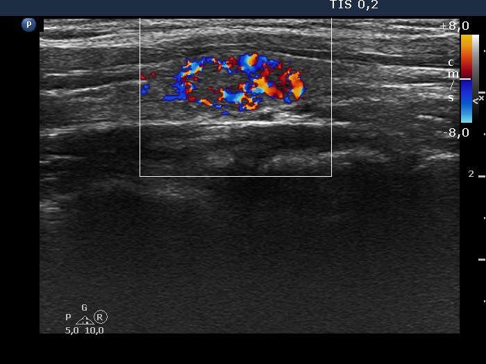 Right lobe, longitudinal scan
