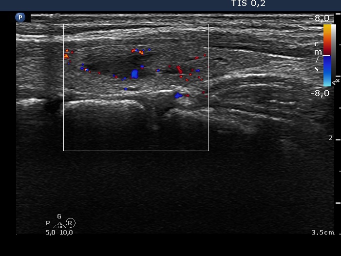 Right lobe, longitudinal scan