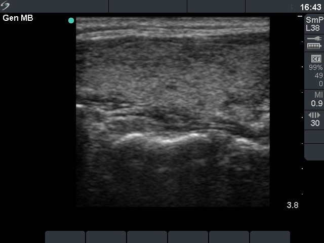 Right lobe, longitudinal scan