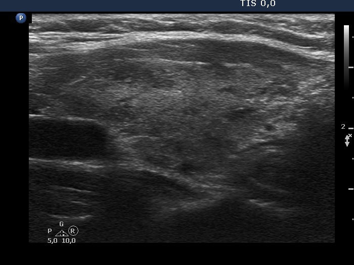 Right lobe, longitudinal scan