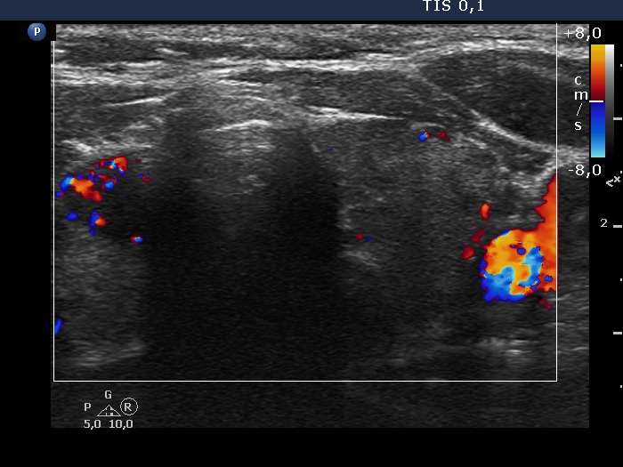 Right lobe, longitudinal scan