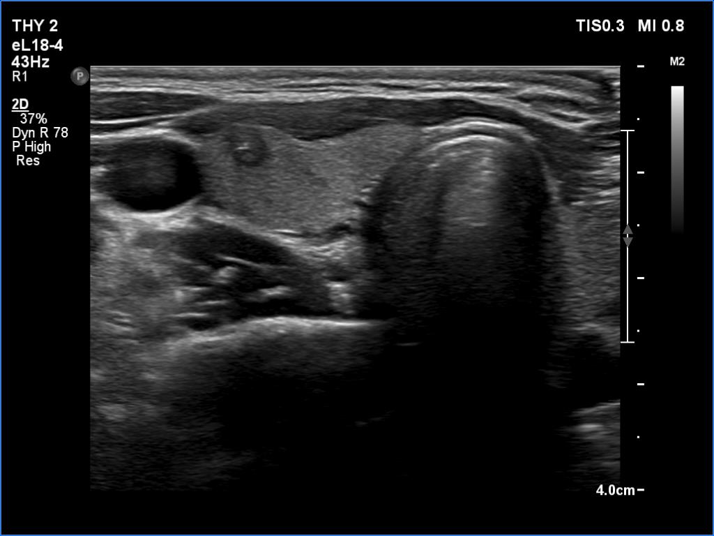 Right lobe, longitudinal scan