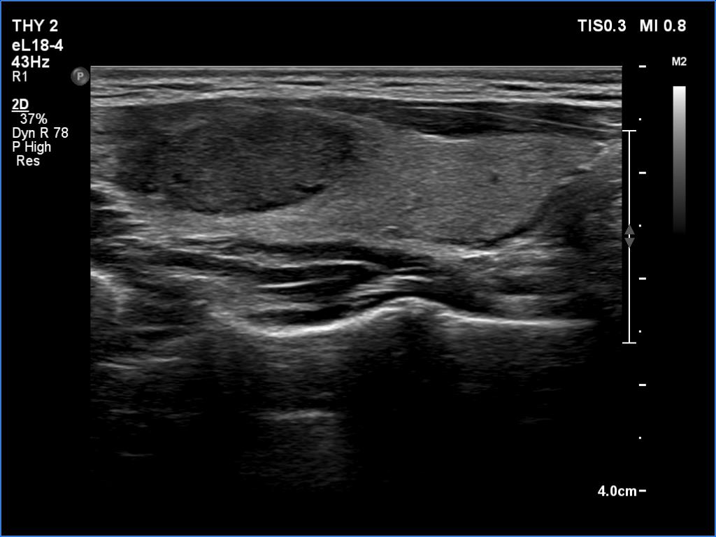Right lobe, longitudinal scan