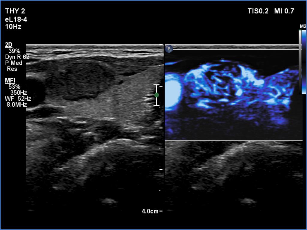 Right lobe, longitudinal scan