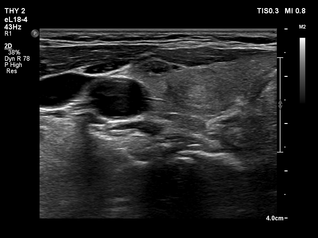 Right lobe, longitudinal scan