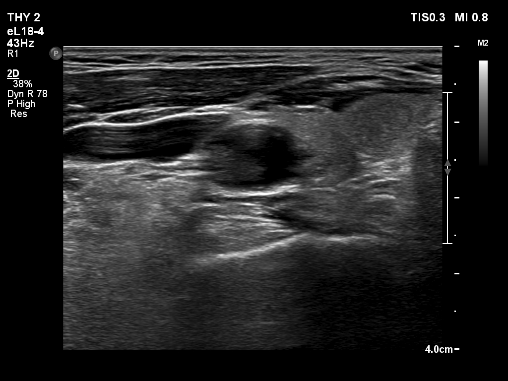 Right lobe, longitudinal scan