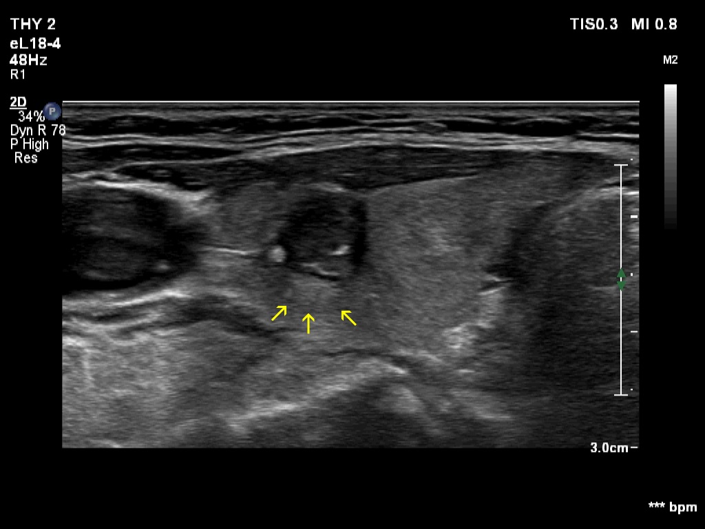 Right lobe, longitudinal scan