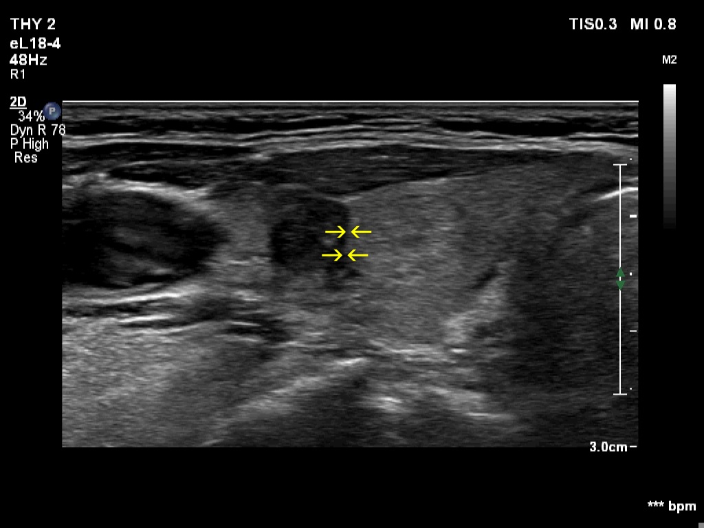 Right lobe, longitudinal scan