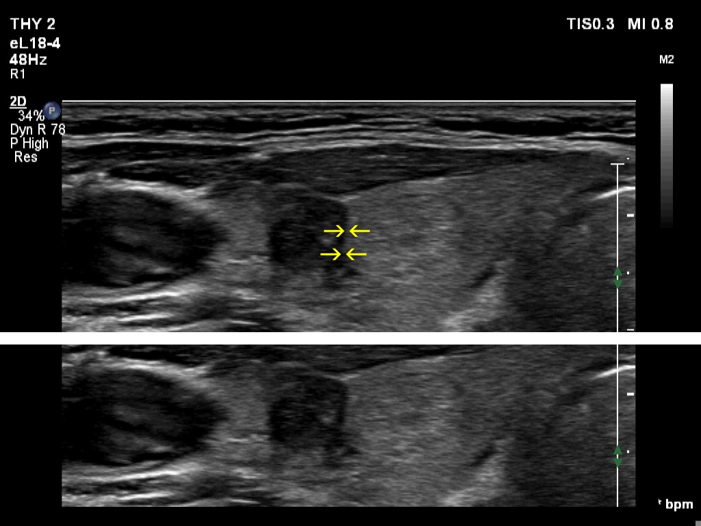 Right lobe, longitudinal scan
