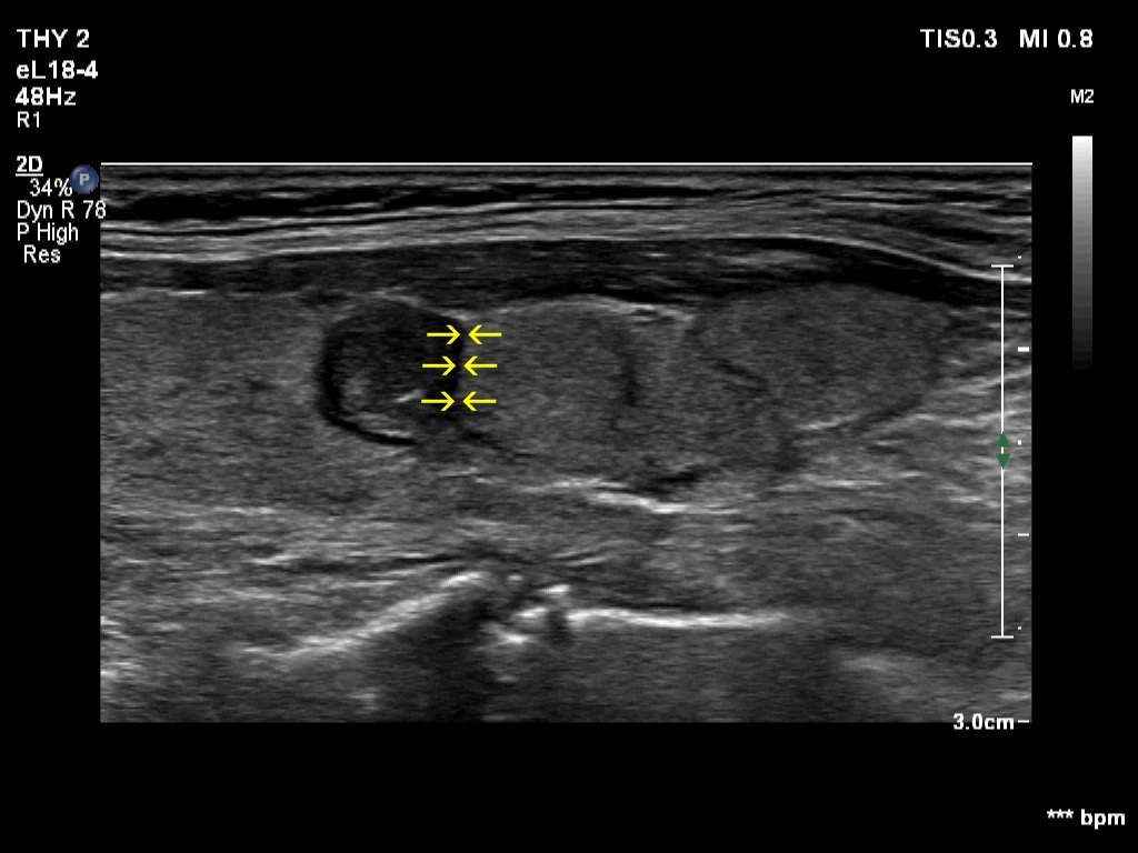 Right lobe, longitudinal scan
