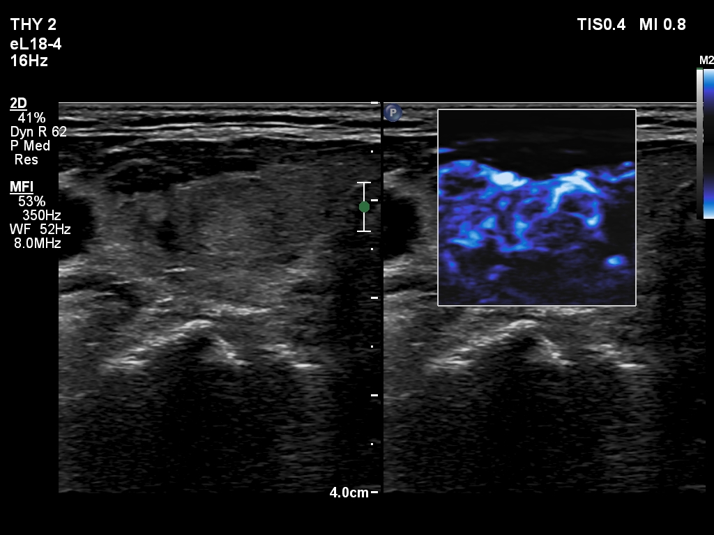 Right lobe, longitudinal scan