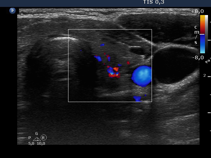 Right lobe, longitudinal scan
