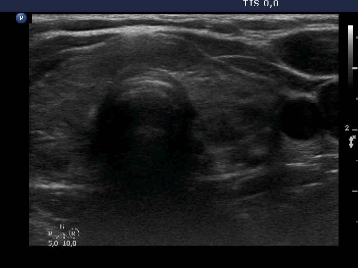 Right lobe, longitudinal scan
