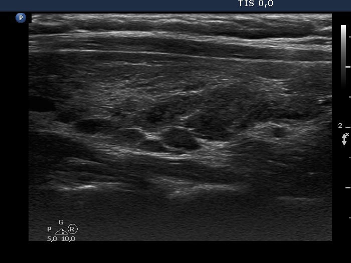 Right lobe, longitudinal scan