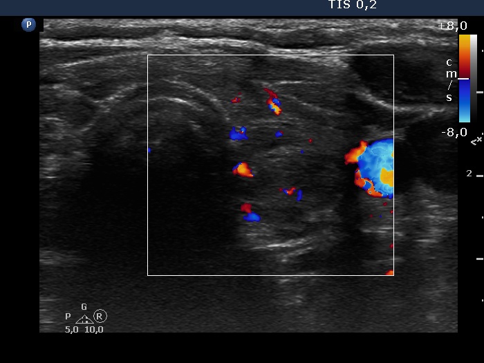 Right lobe, longitudinal scan