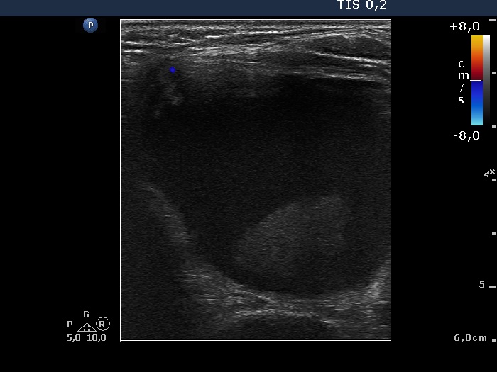 Right lobe, longitudinal scan