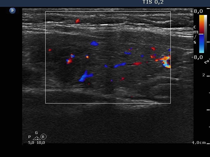 Right lobe, longitudinal scan