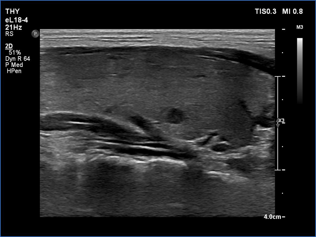 Right lobe, longitudinal scan